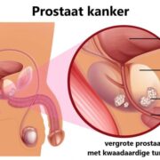 ‘Plasklachten zijn een uiting van een goedaardige vergroting van de prostaat’