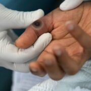 Jamaica records another monkeypox case Loop Jamaica