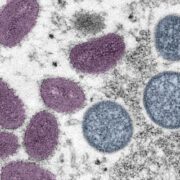 Letter: No place for stigmatisation regarding monkeypox