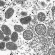 Aumentan a 134 los casos de viruela símica en Puerto Rico